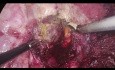 Resección hepática toracoscópica de lesión localizada en el segmento 7 