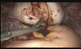 Mioma uterino bien vascularizado (8,6 x 7 cm)