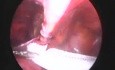 Cirugía de hernia inguinal - método laparoscópico
