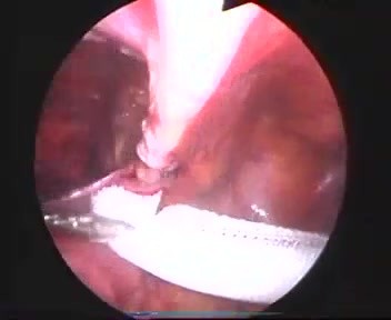 Cirugía de hernia inguinal - método laparoscópico