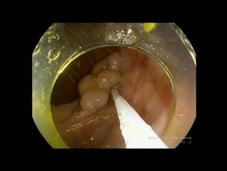 DSE de LST-G en colon ascendente - video del procedimiento, sin edición