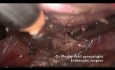 Paciente virgen y laparoscopia por prolapso de mioma vaginal