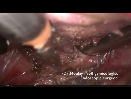 Paciente virgen y laparoscopia por prolapso de mioma vaginal