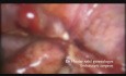 Salpingectomía laparoscópica por embarazo ectópico roto