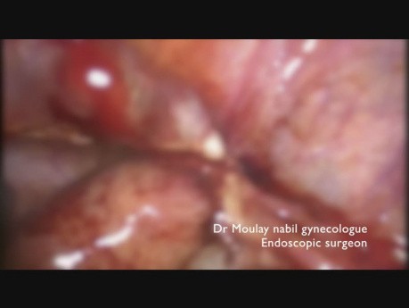 Salpingectomía laparoscópica por embarazo ectópico roto