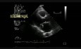 Endocarditis infecciosa en la estenosis mitral 1