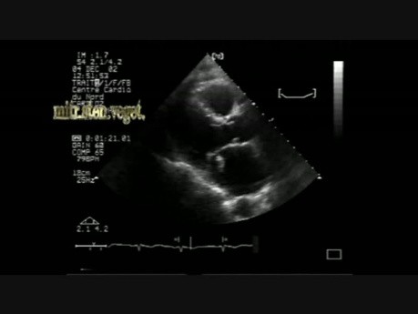 Endocarditis infecciosa en la estenosis mitral 1