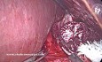 Dominio de la miotomía de Heller: preservación del nervio vago anterior durante la miotomía de Heller laparoscópica