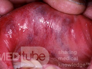 Malformación vascular del labio
