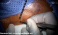 Lewa standardowa kraniotomia zasigmoidalna z implantacją pniowego implantu słuchowego (ABI)