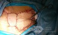 Cáncer de mama quimiorresistente triple negativo - el gran defecto del tejido se llenó con un colgajo dorsal ancho