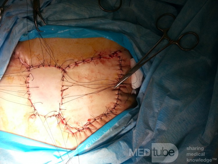 Cáncer de mama quimiorresistente triple negativo - el gran defecto del tejido se llenó con un colgajo dorsal ancho