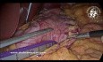 Gastrectomía en manga en caso de neumatosis intestinal