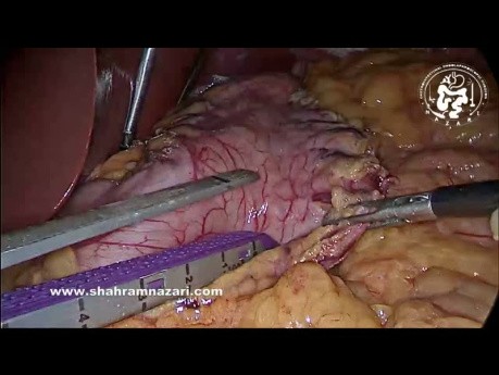 Gastrectomía en manga en caso de neumatosis intestinal