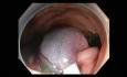Complicaciones de la resección mucosa endoscópica (RME) - sangrado en colon ascendente - caso 1A