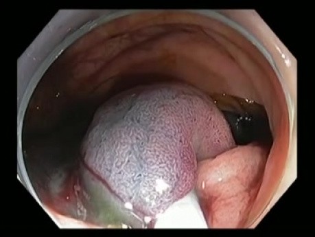 Complicaciones de la resección mucosa endoscópica (RME) - sangrado en colon ascendente - caso 1A