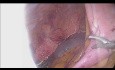 Anastomosis Intracorpórea en Hemicolectomía Derecha Laparoscópica
