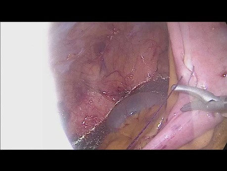 Anastomosis Intracorpórea en Hemicolectomía Derecha Laparoscópica