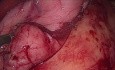 Control del sangrado mediante gastrectomía en manga ("sleeve")