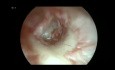 Timpanoplastia endoscópica de cartílago tipo I