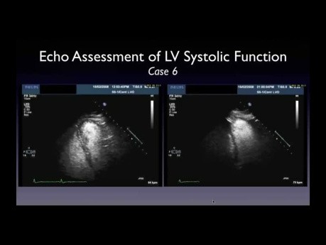Un enfoque práctico de la fracción de eyección del ventrículo izquierdo (FEVI) mediante ecocardiografía