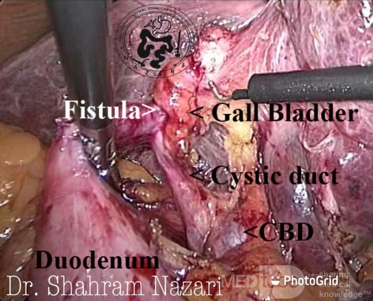 Fístula colecistoduodenal