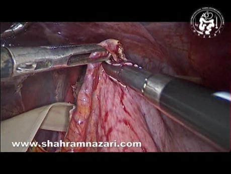 Miotomía de Heller laparoscópica