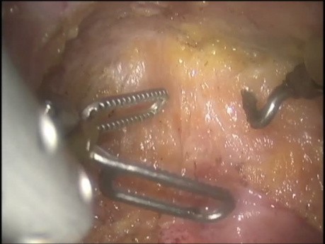 Escisión mesorectal total robótica - solución práctica