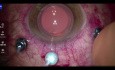 Cirugía de injerto de membrana amniótica para el agujero macular persistente