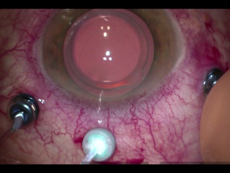 Cirugía de injerto de membrana amniótica para el agujero macular persistente
