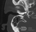 Exostosis de la tomografía computarizada del canal externo