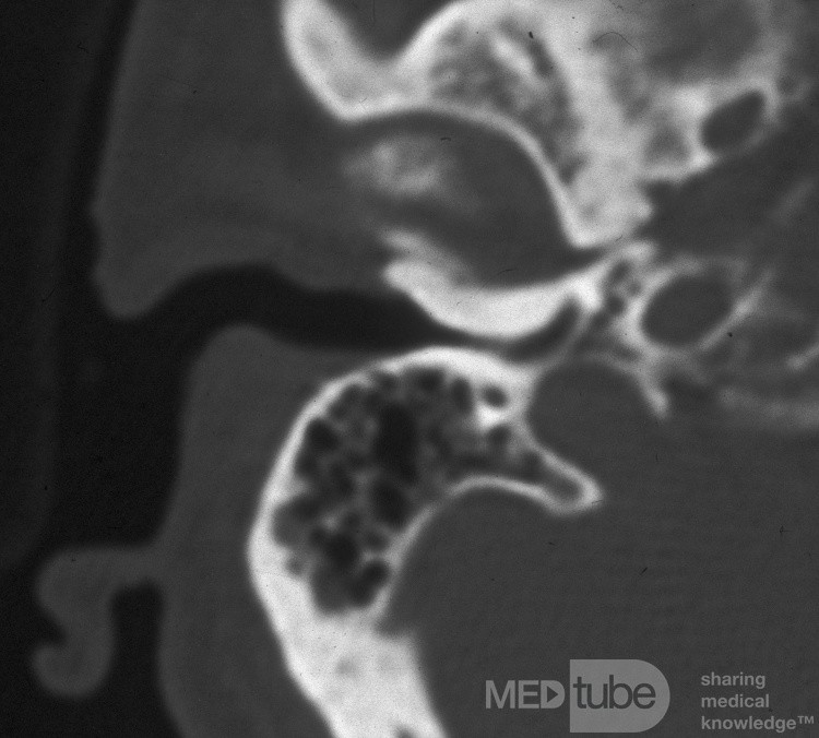 Exostosis de la tomografía computarizada del canal externo
