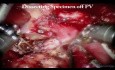 Pancreaticoduodenectomía robótica con colecistectomía