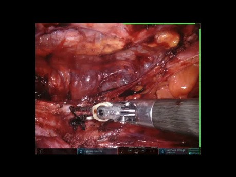 Tu Mediastino pós Quimioterapia - Robotica