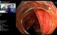 Resección endoscópica de la mucosa de pólipos (REM)