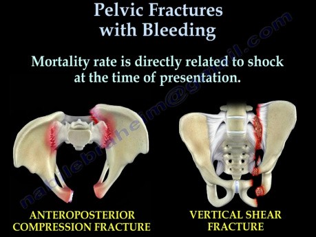 Fracturas pélvicas con sangrado