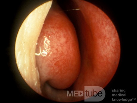 Cornete inferior normal [derecha]