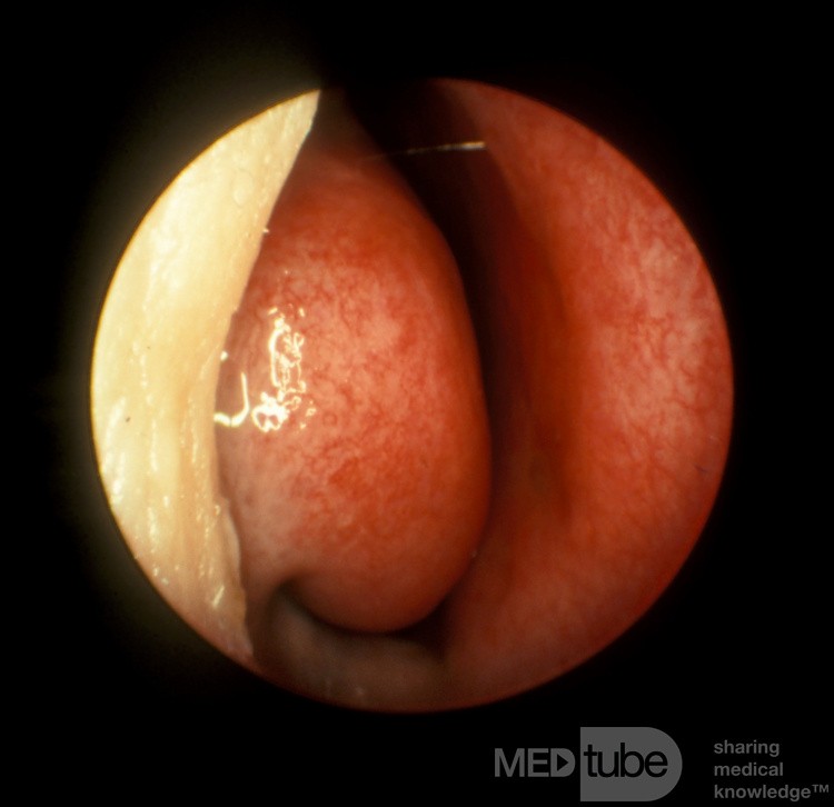 Cornete inferior normal [derecha]