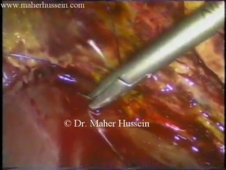 Conducto de Luschka - ligadura laparoscópica