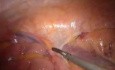 Hemicolectomía derecha laparoscópica