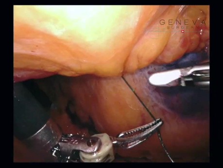 TAPP robótica M2-3 W1 Hernia de línea media Acoplamiento lateral estándar