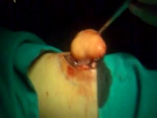 Extirpación de lipoma en el antebrazo