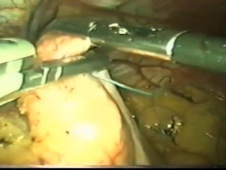 De la laparoscopia convencional a la funduplicatura laparoendoscópica en un solo sitio - El camino hacia la ERGE