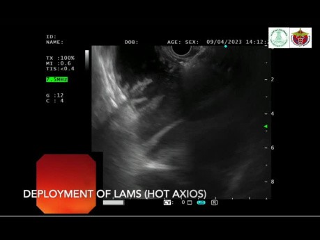 Obstrucción del síndrome del asa aferente maligna tratada con gastroyeyunostomía LAMS guiada por USE