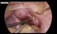 Miomectomía laparoscópica de un mioma uterino de la pared posterior con endometriosis asociada