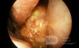 Papiloma invertido Cavidad nasal derecha 