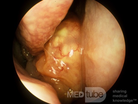 Papiloma invertido Cavidad nasal derecha 