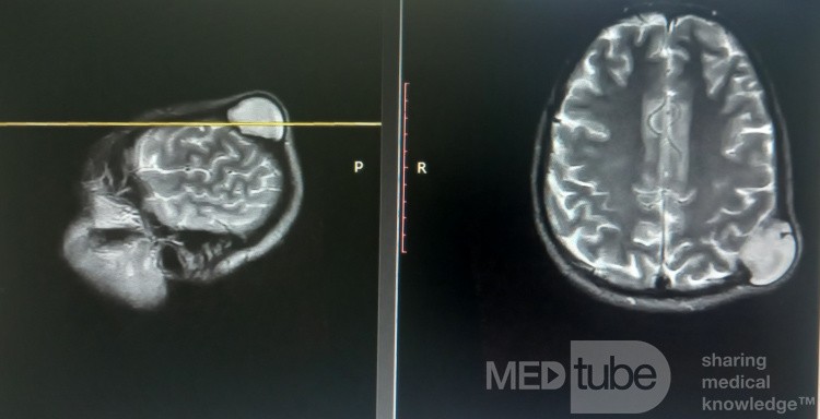Lesión Tumoral Epicraneal