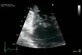 Insuficiencia valvular mitral