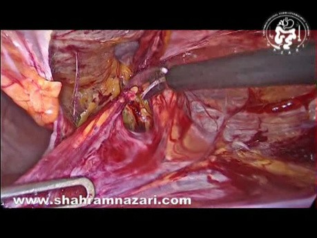 Hernia Inguinal en "alforja" (saddlebag)